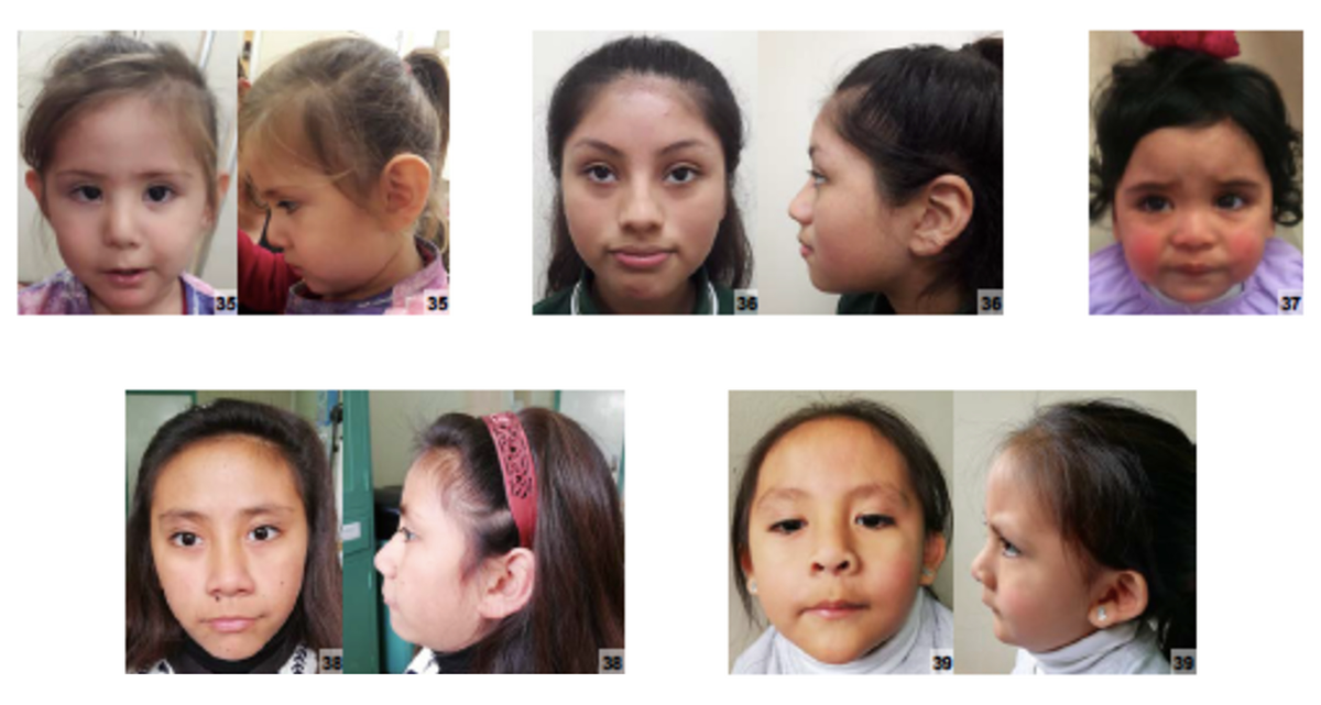 Девочки с синдромом Шерешевского-Тернера (Википедия). Широкая шея, узко посаженные уши, низкорослость, бесплодие - это и многие другие проявления данного синдрома.