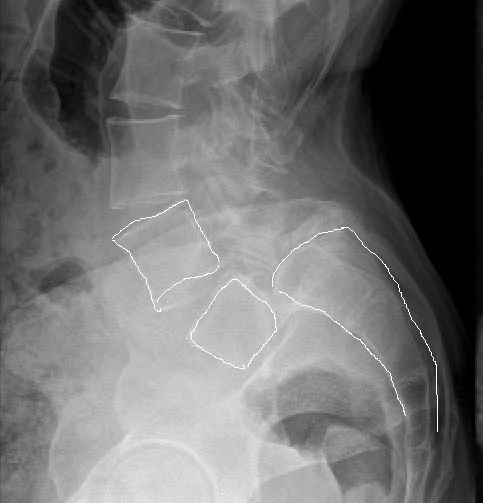 Не листез, а листезише!!!! Полное сползание позвонка L5 по крестцу!