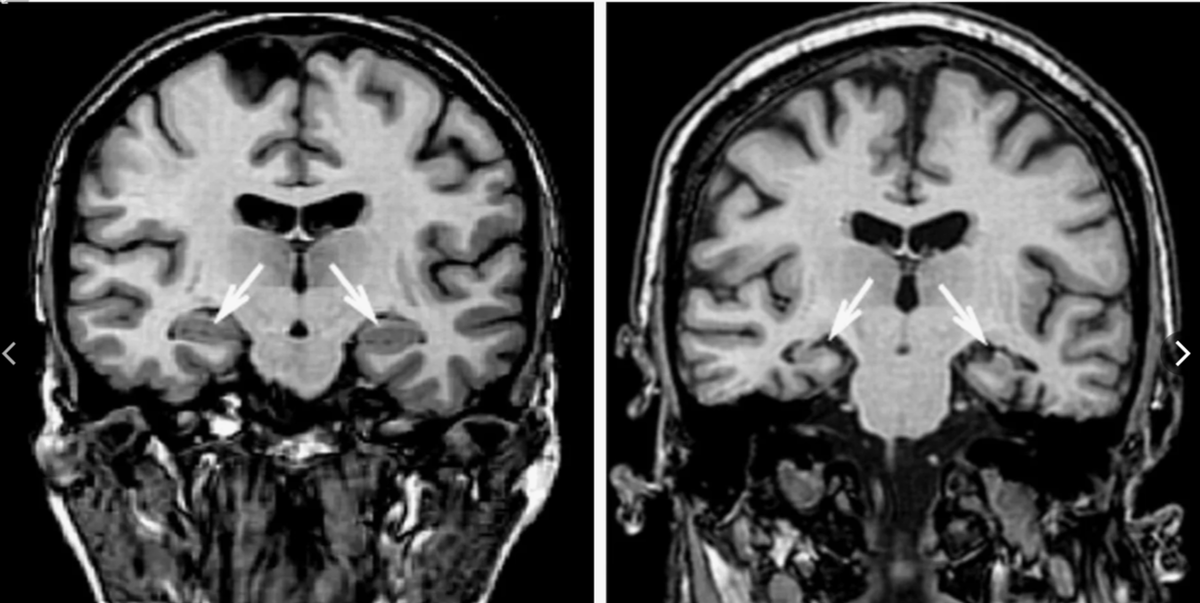 МРТ головного мозга, фронтальный срез. Слева стрелками показан здоровый гиппокамп с каждой стороны, справа - при амнезии (резко уменьшен в объеме).