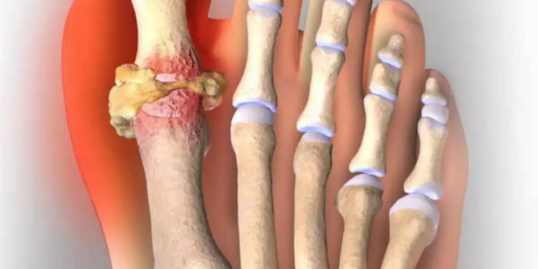 Разрушает суставы и почки — главное о подагре