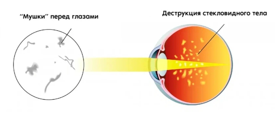 Болят глаза и мушки