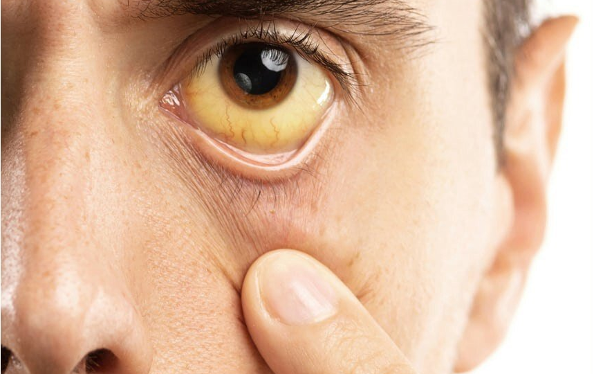 Синдром Жильбера — что это такое и что делать с таким состоянием