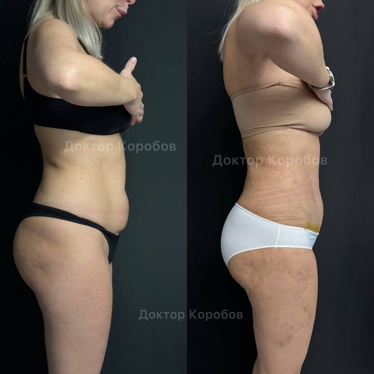 Липосакция живота, поясницы, боковых зон, зон галифе +  миниабдоминопластика. Результат через 2 недели после операции. Отеки, конечно, еще есть, но уже виден классный результат