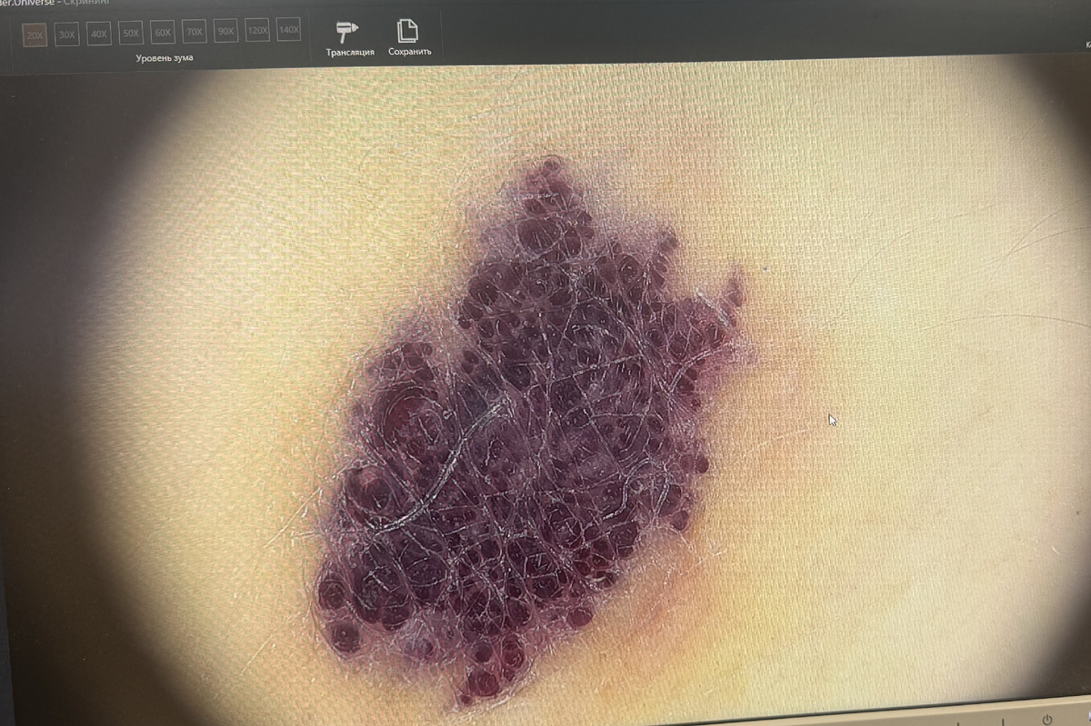 Травмированная гемангиома. Дерматоскопия. Увеличение х 20