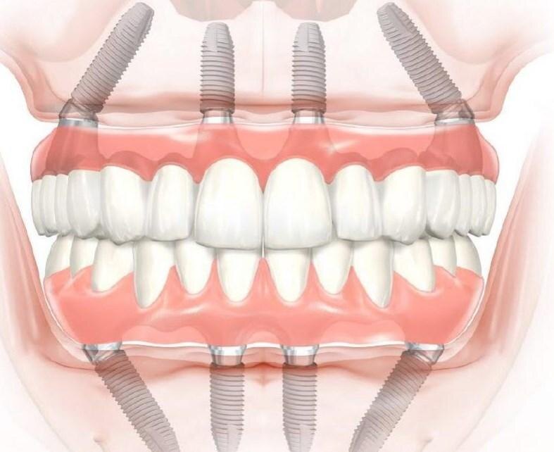 Протезирование All-on-4