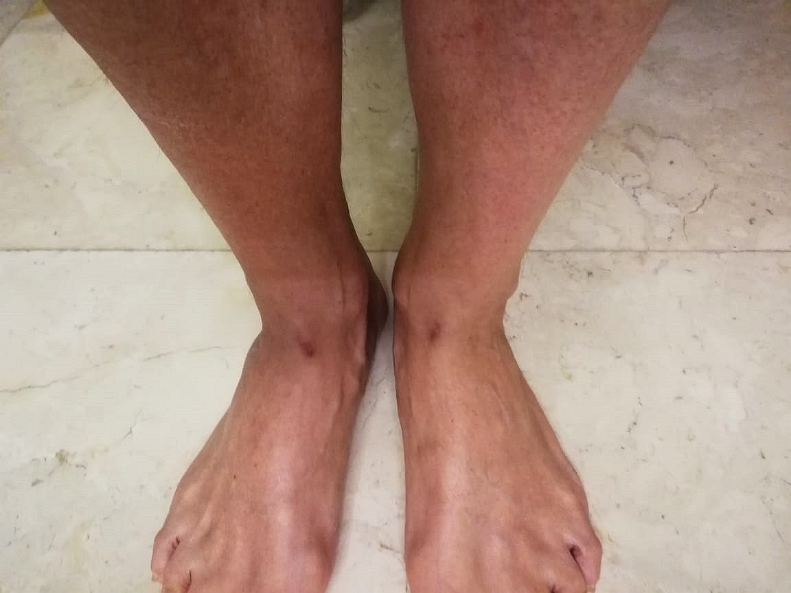 А это только что свои ноги сфотографировал на телефон и через вотсапп переслал, поэтому картинка, конечно, не рубенсовская. Но суть видна - сюда гвозди гораздо удобнее забивать, если человек на кресте висит  - пятки будут в крест упираться и любой плотник с задачей легко справится...  