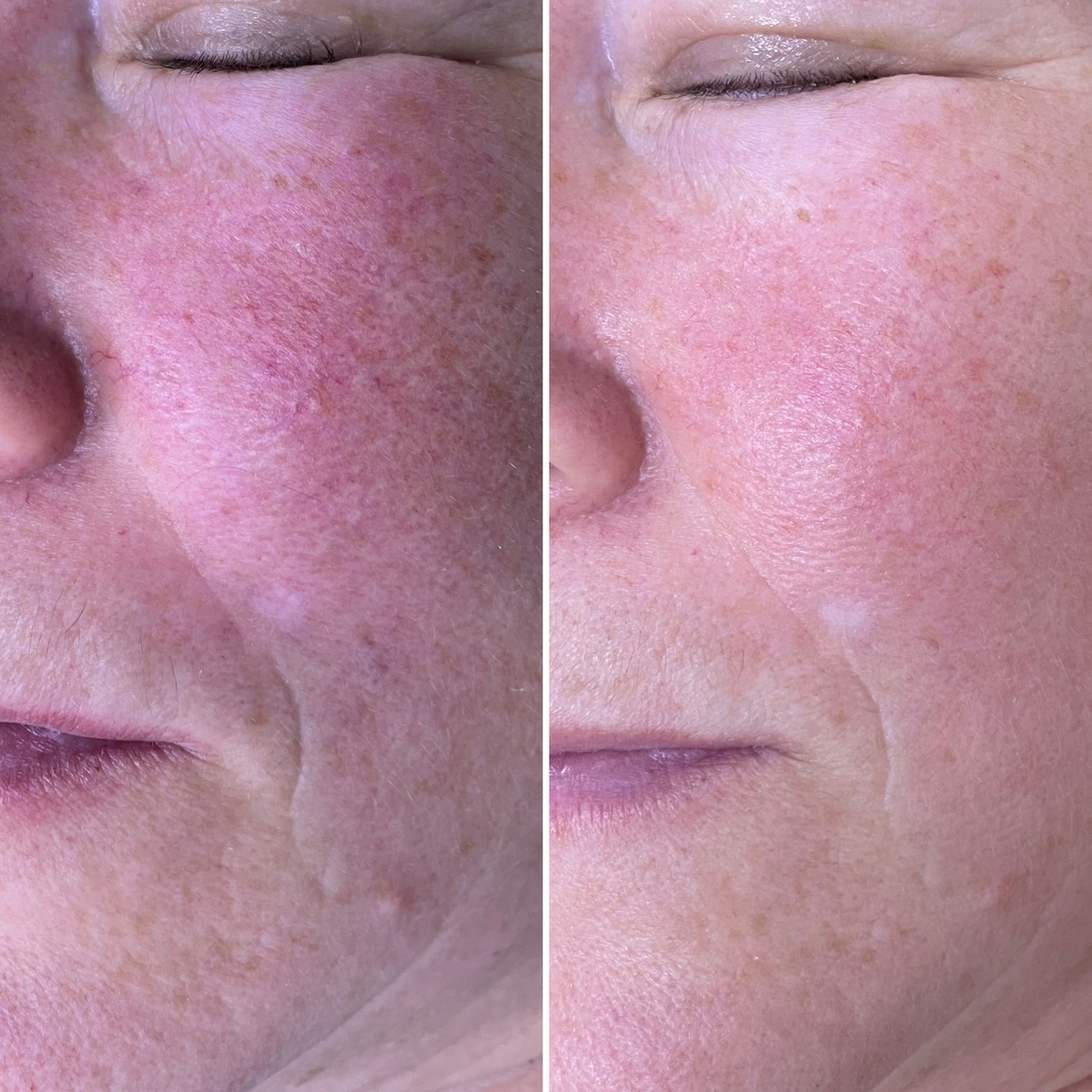 Результат лечения купероза методом накожной лазеротерапии