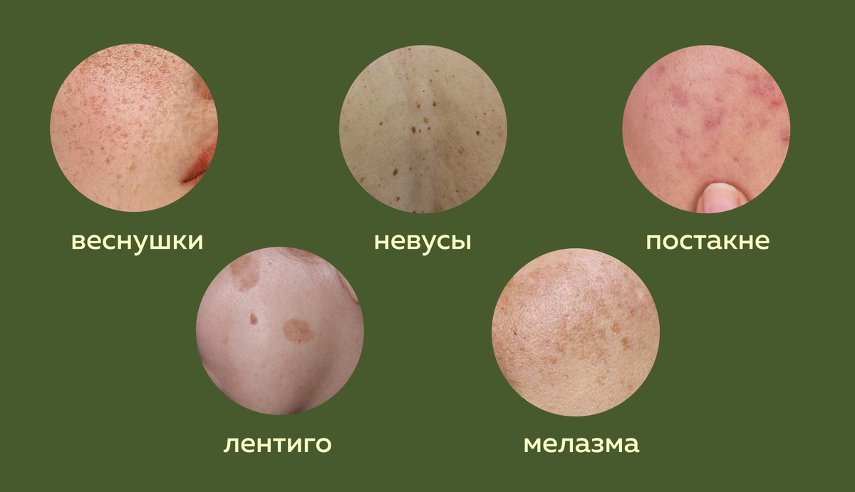 Виды пигментации кожи
