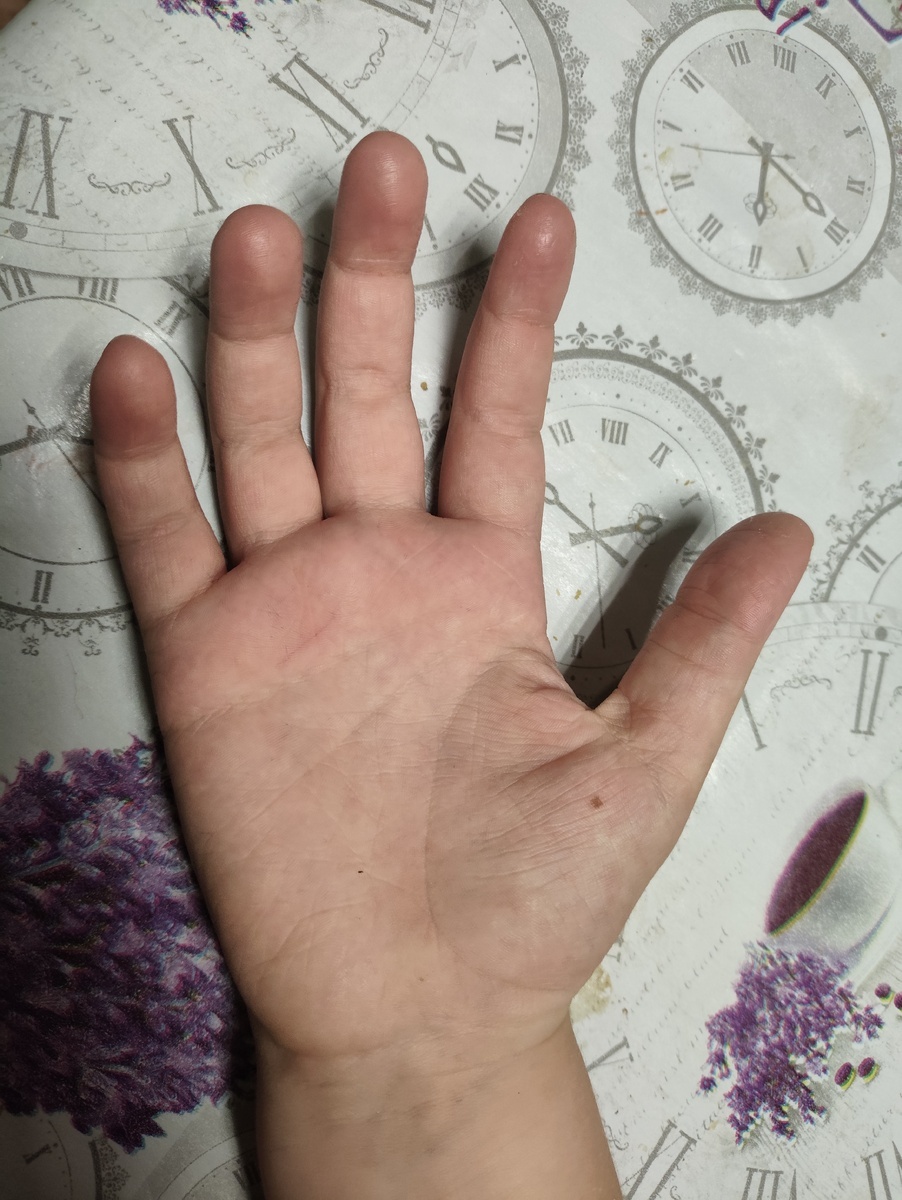 Фото с моего канала Дзен. Родинка на ладони. 