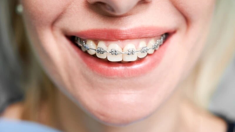     Брекеты Freepic