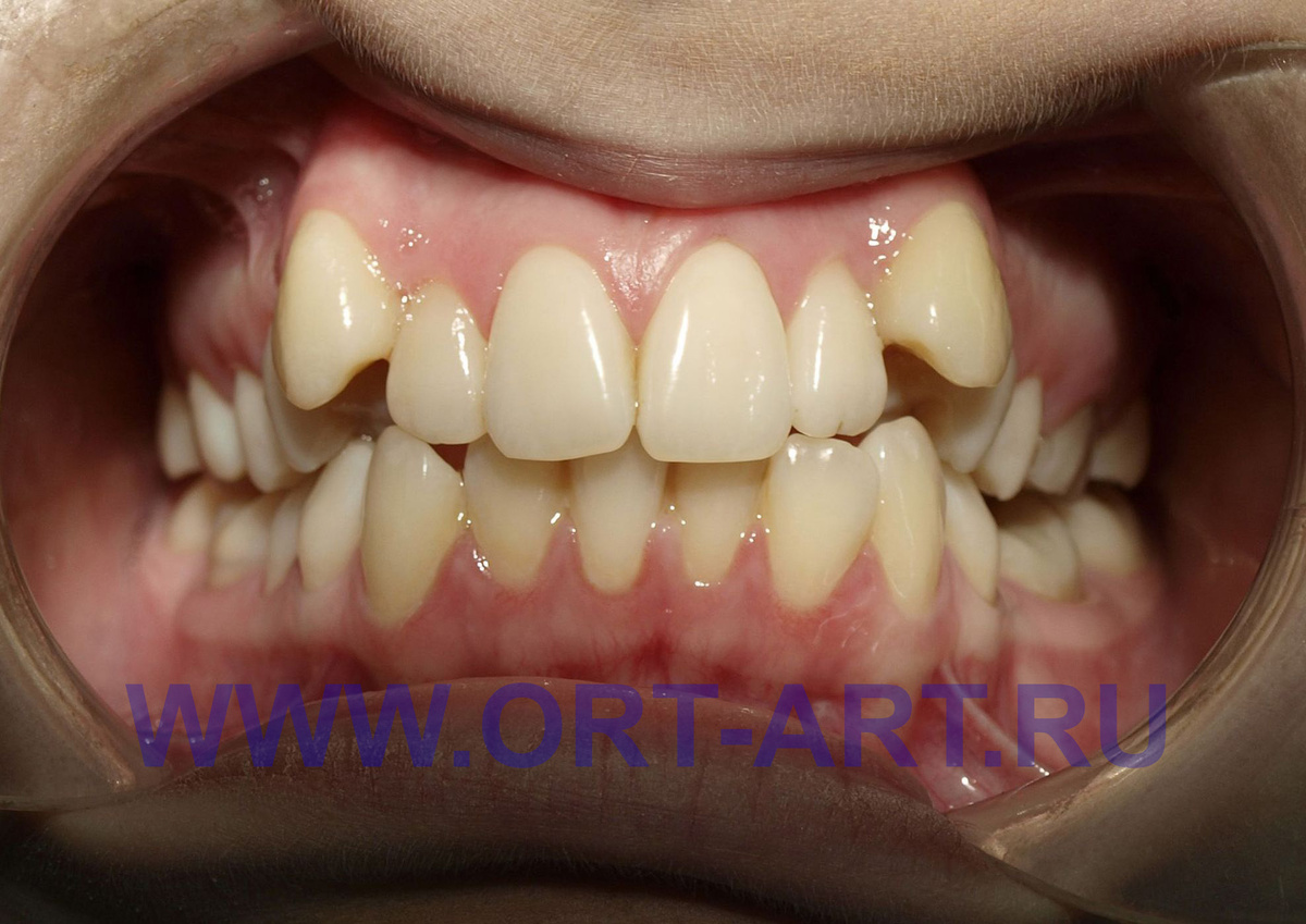 Кривые зубы...