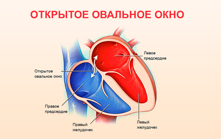 Сброс крови возможен в обе стороны