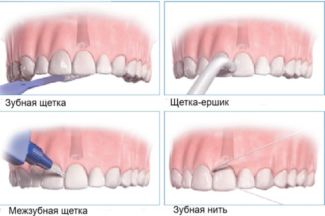 Средства для очищения зубного имплантата