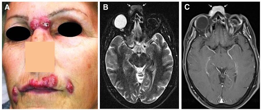 временные кожные наполнители с гиалуронкой, введенные 7 месяцев назад, с комками на уровне верхней губы (стрелочки).