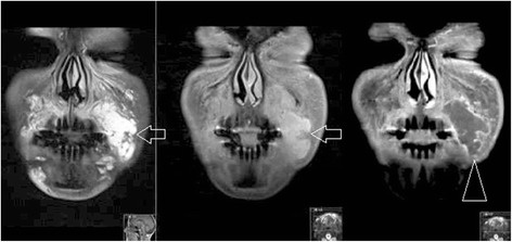 формирование абсцесса в области левой носогубной борозды (стрелочка) после введения наполнителя с полиакриламидом.