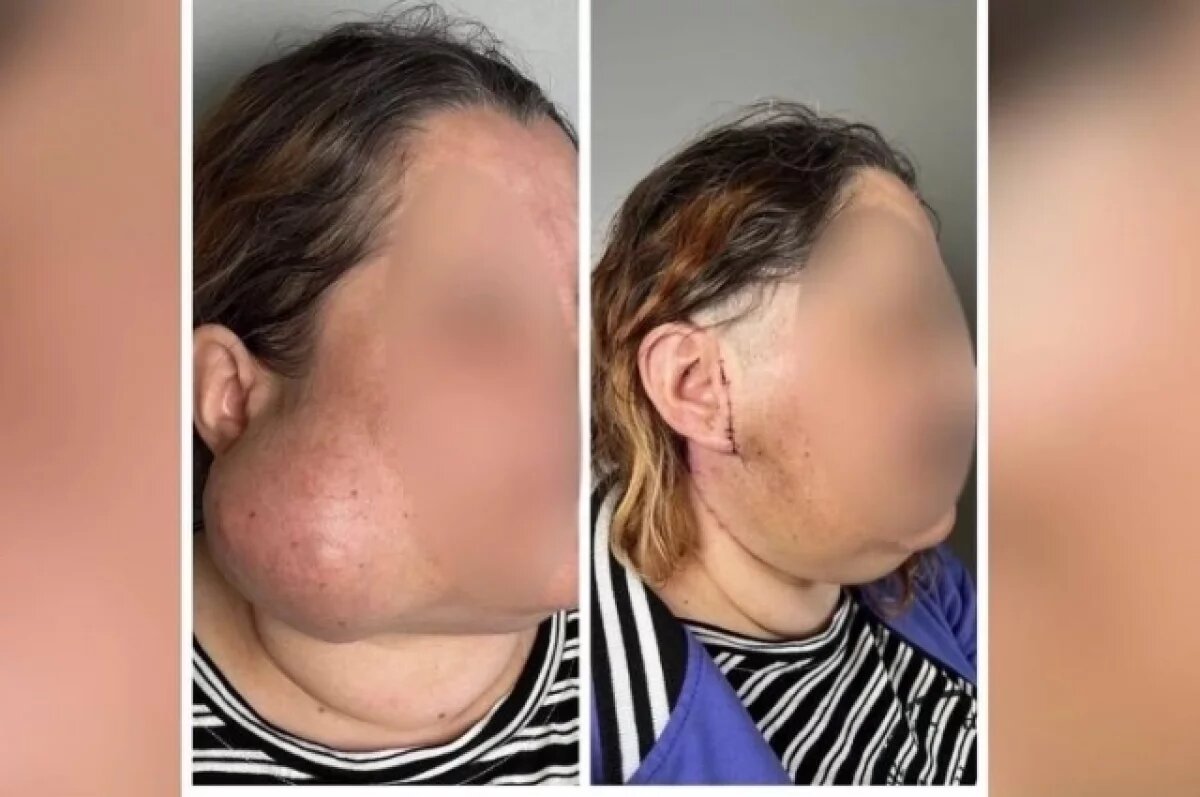    Уфимские хирурги успешно удалили гигантскую опухоль с лица женщины