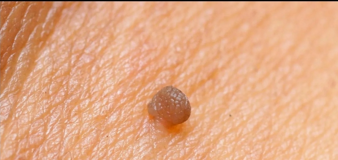 Папиллома кожи. Фото из сети Интернет.