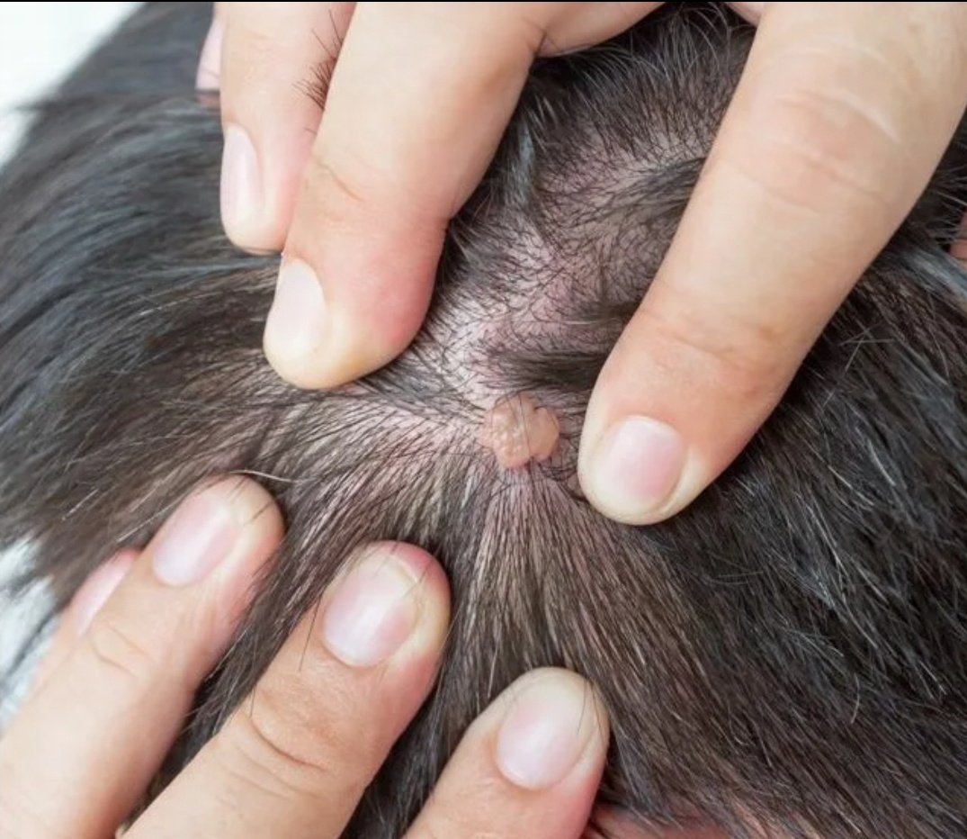 Папиллома кожи волосистой части головы. Фото из сети Интернет.