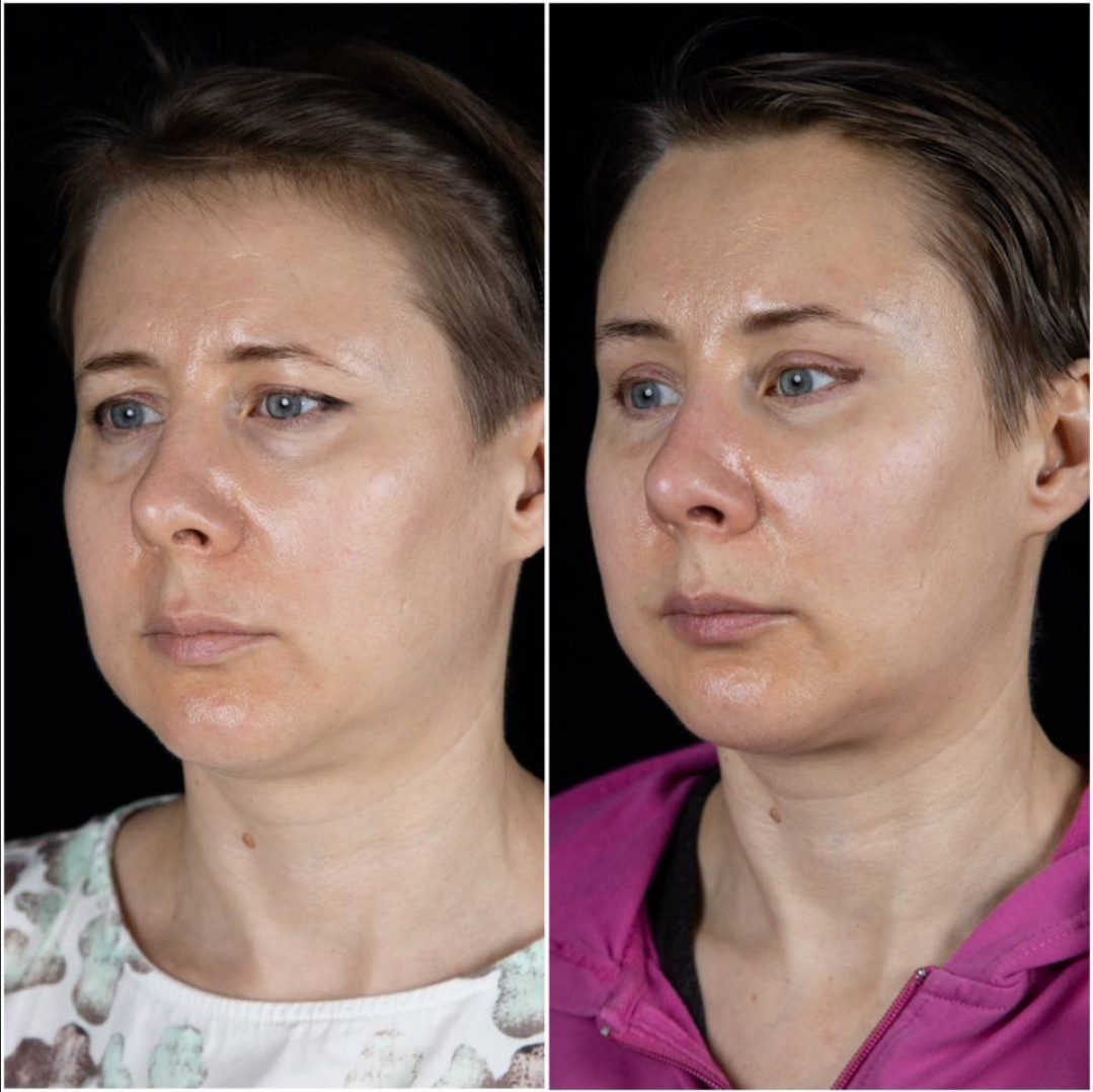 2 месяца после операции: эндоскопическая подтяжка лба, верхняя блефаропластика, первый этап липофилинга лица