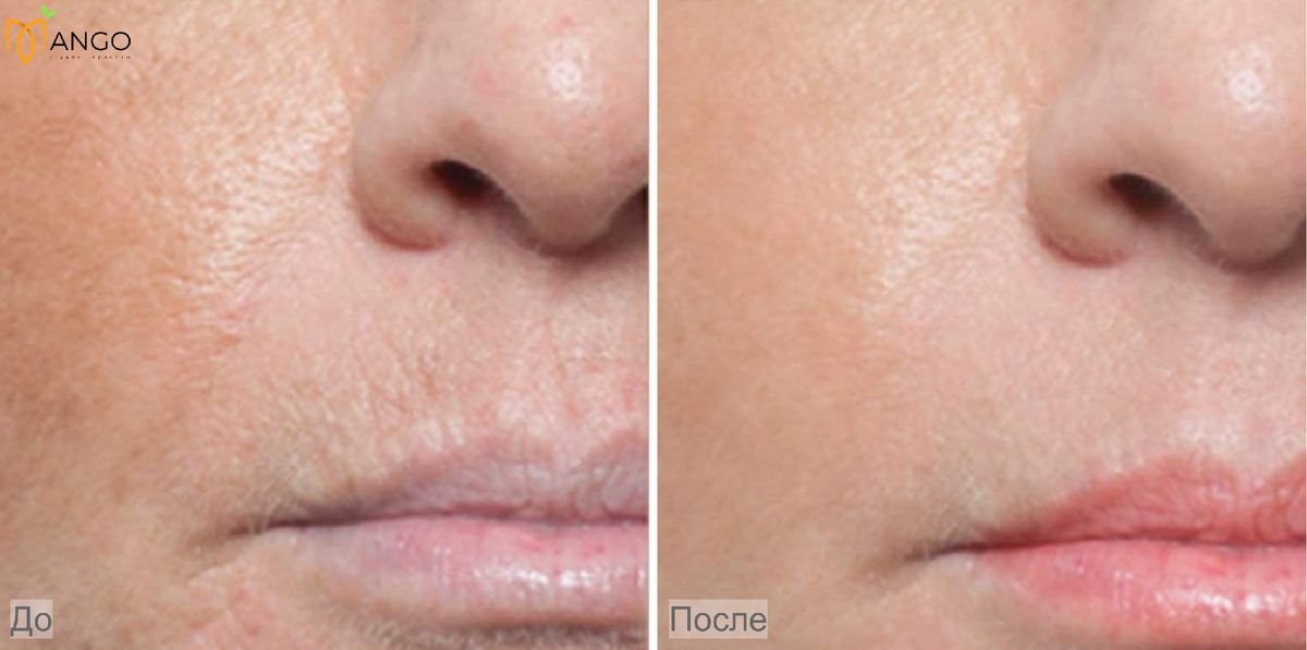 Эффект от курсового применения плацентарной мезотерапии