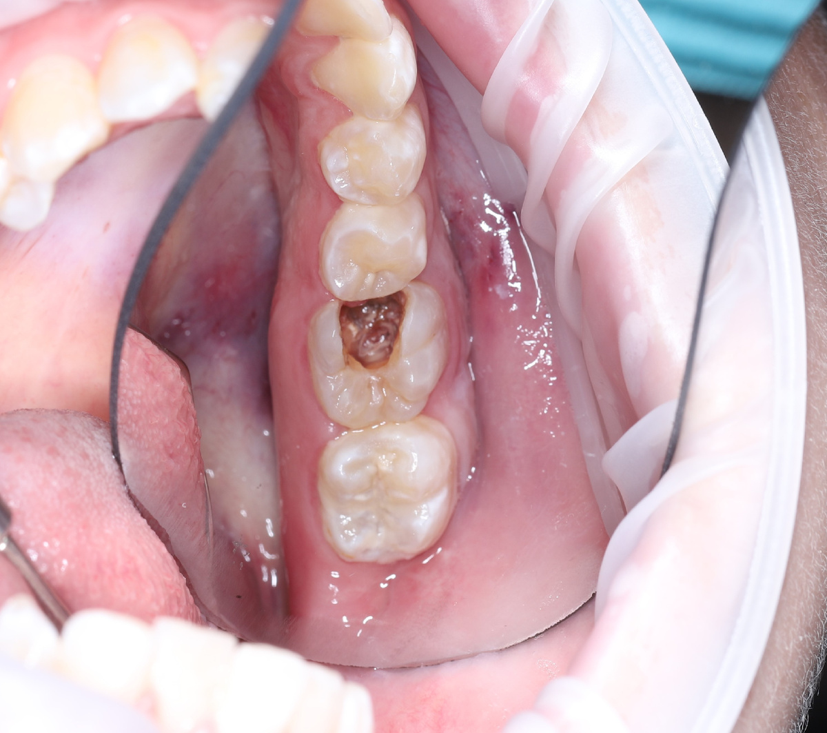 Зубик с большой дырочкой 