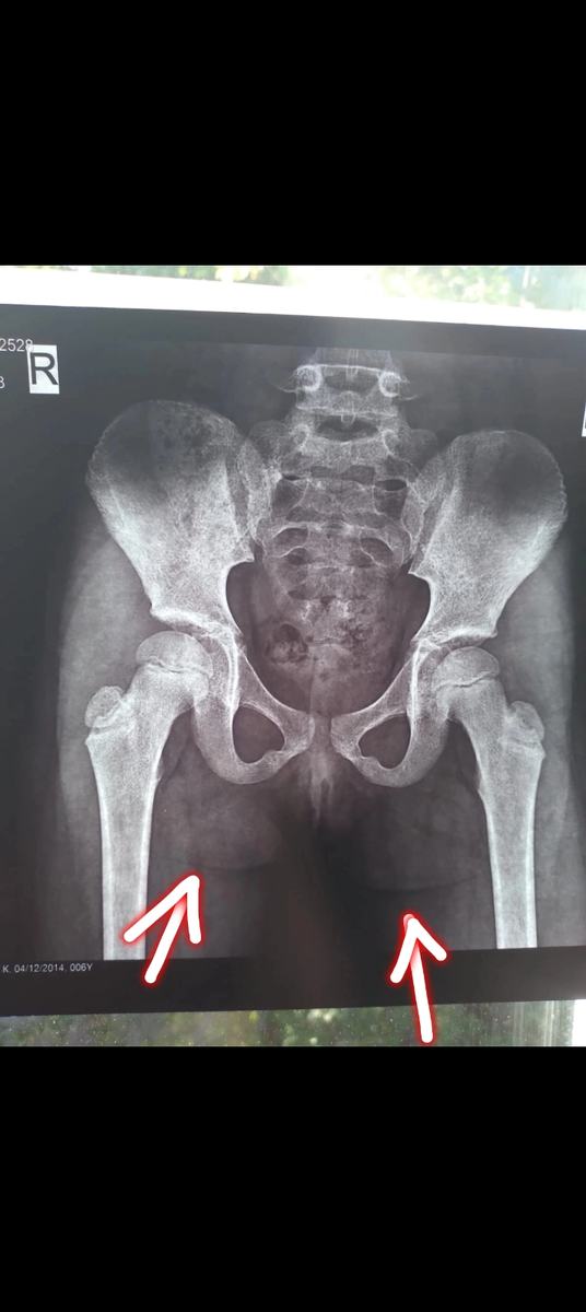 Тазобедренные суставы ребенка с гфф