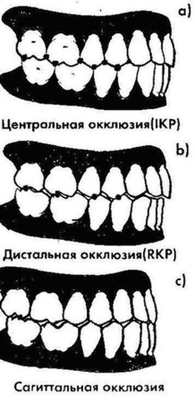 a) Центральная окклюзия; b) Задняя (дистальная) окклюзия; c) Передняя (сагиттальная) окклюзия 
