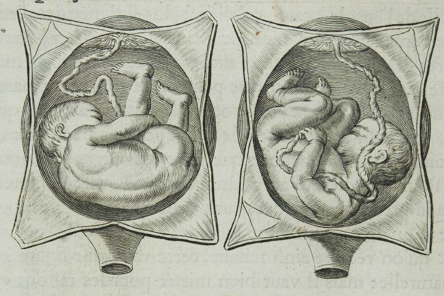  Плод в матке. Гравюра Франсуа Морисо
Фото: Wellcomeimages.com