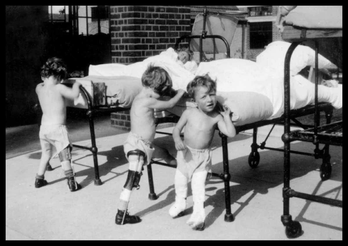 Частичный паралич нижних конечностей у детей младше 6 лет, вызванный полиомиелитом