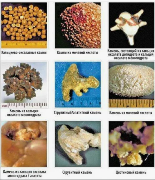 Типы камней в почках в зависимости от химического состава