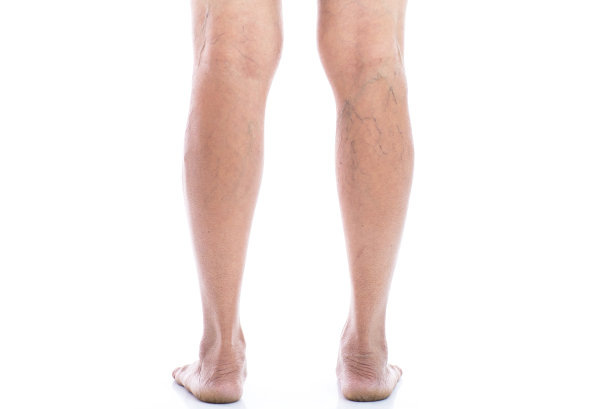 Картина варикозного расширения вен на нижних конечностях