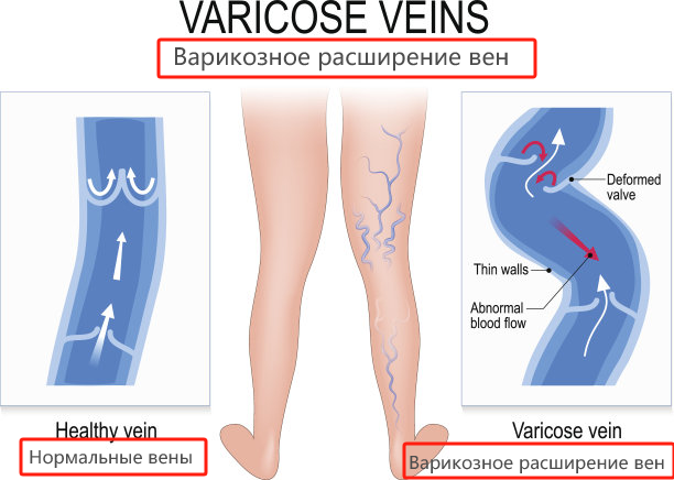 Сравнение нормальных вен и варикозного расширения вен