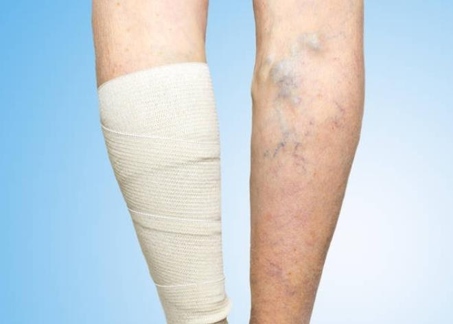 Опасность варикозного расширения вен нижних конечностей