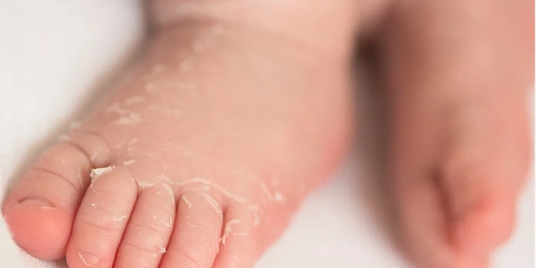 Эпидемия Коксаки - стоит ли бояться?