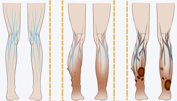 Поэтому необходимо сознательно предотвращать появление варикозного расширения вен на нижних конечностях в повседневной жизни.