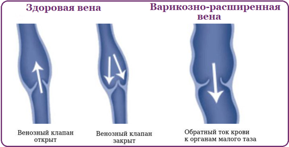 Несостоятельность клапанов вен при варикоцеле