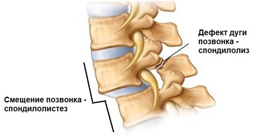 Спондилолиз и спондилолистез