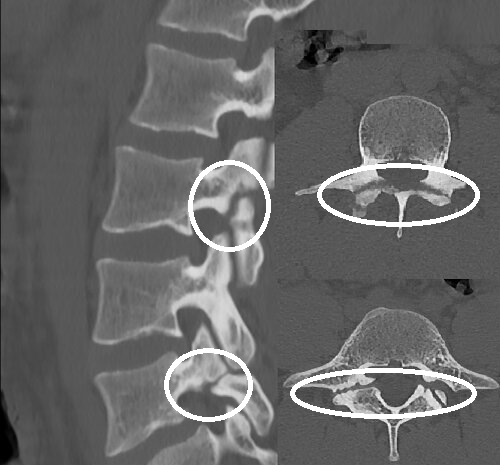 Спондилолиз (дефект) L3 и L5 без спондолистеза (смещения)