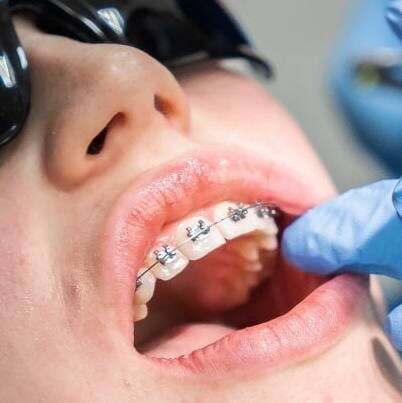 брекет-система