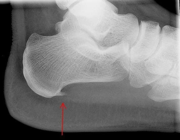 Пример визуализации пяточного остеофита на рентгеновском снимке ступни