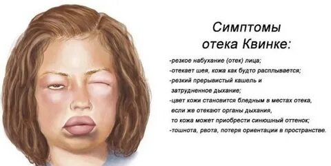 Симптоиы отёка
