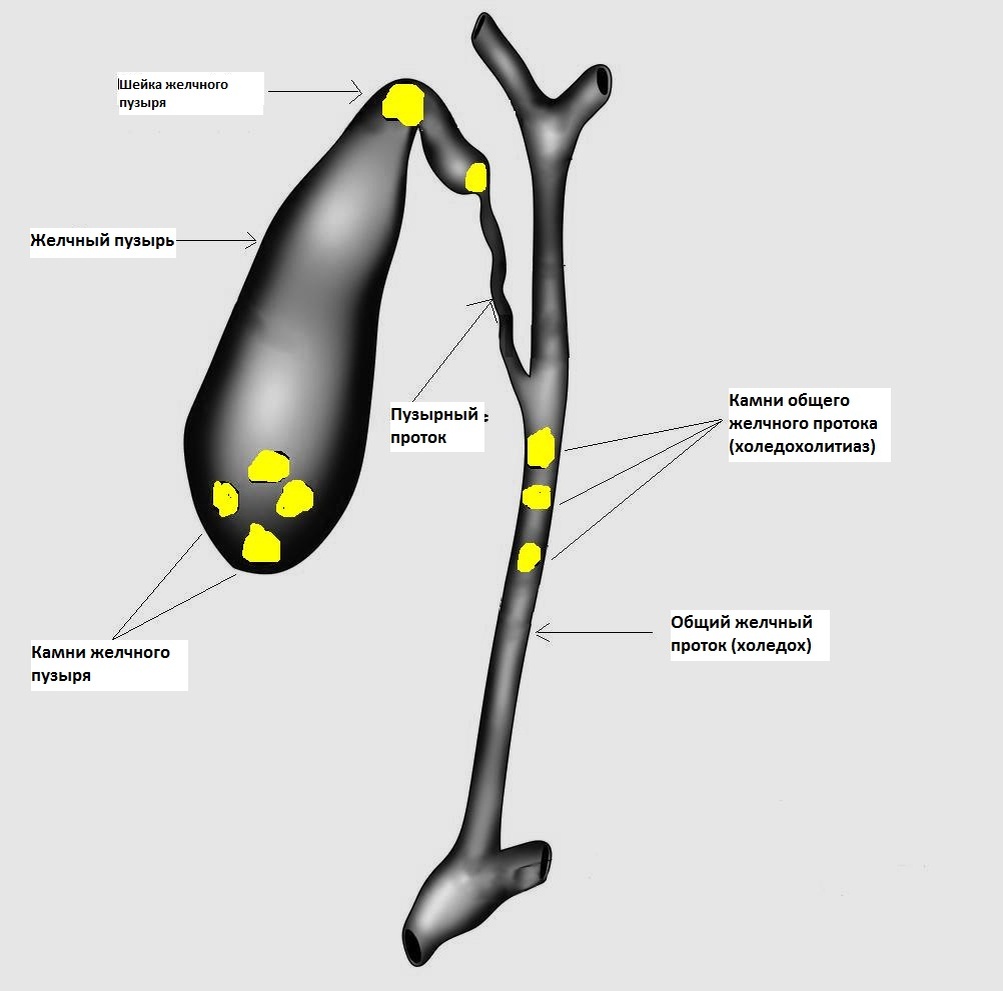 Основная локализация камней при ЖКБ