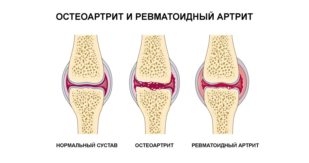 Ревматоидный артрит против остеоартрита: как отличить и вылечить боль в суставах?