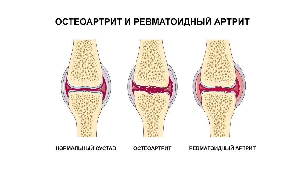 Лечение ревматоидного артрита и остеоартрита