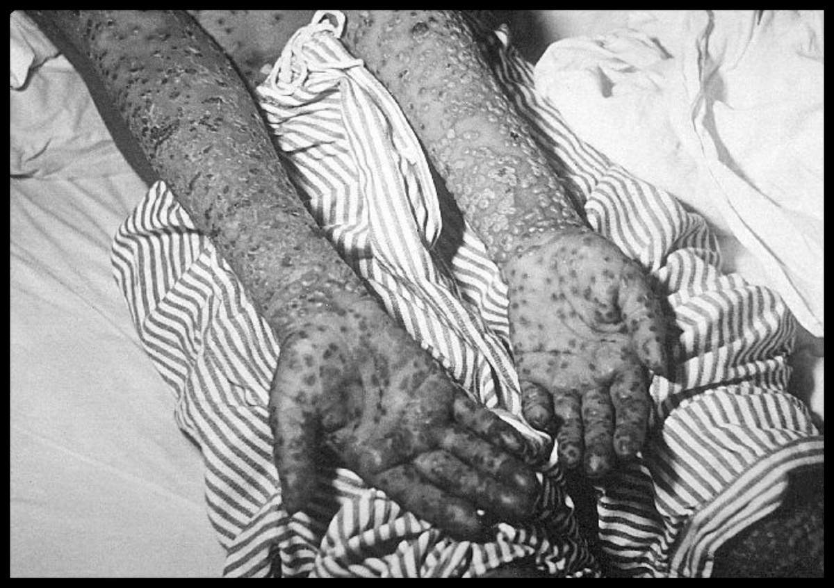 Сыпь на теле при заболевании натуральной оспы