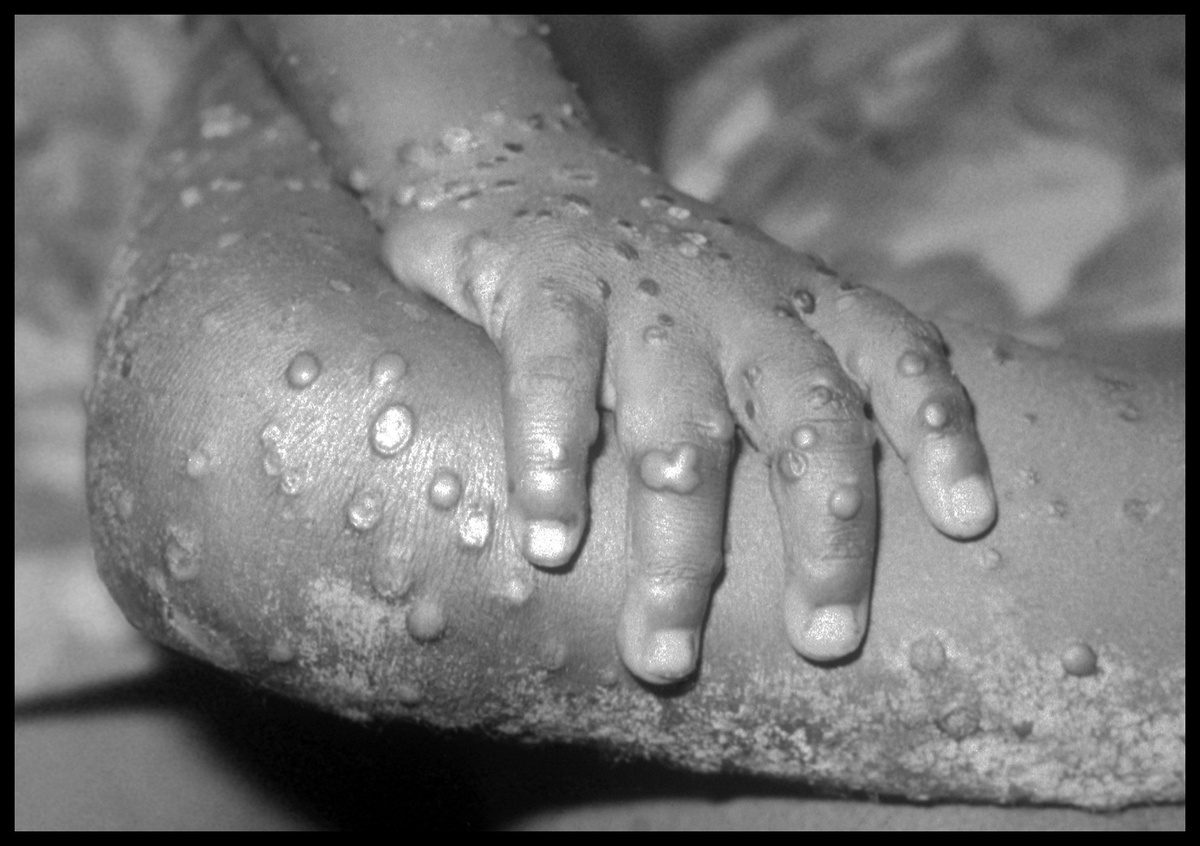 Больной натуральной оспой
