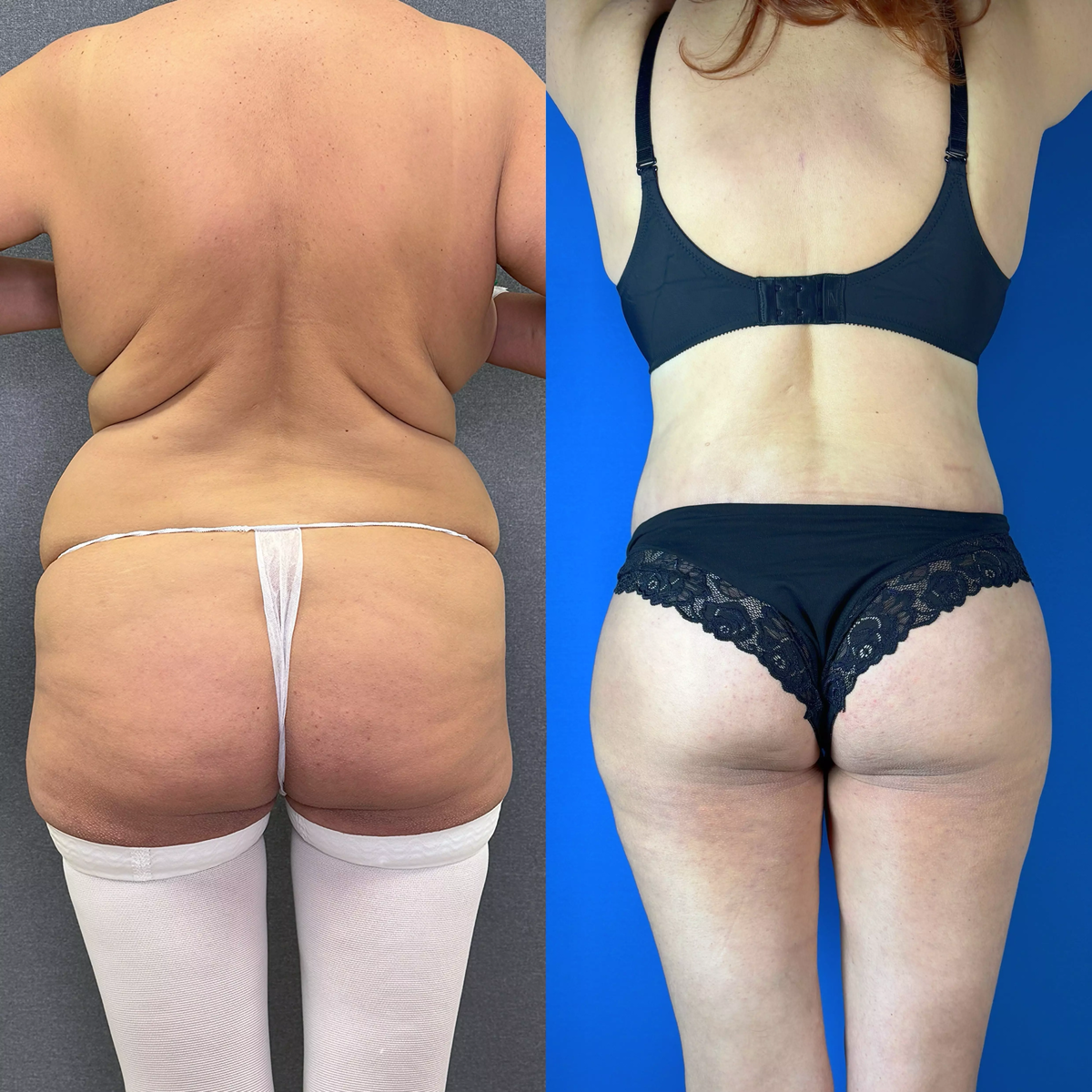 На фото пациентка Данилы Лупина. Имеются противопоказания, необходима консультация специалиста