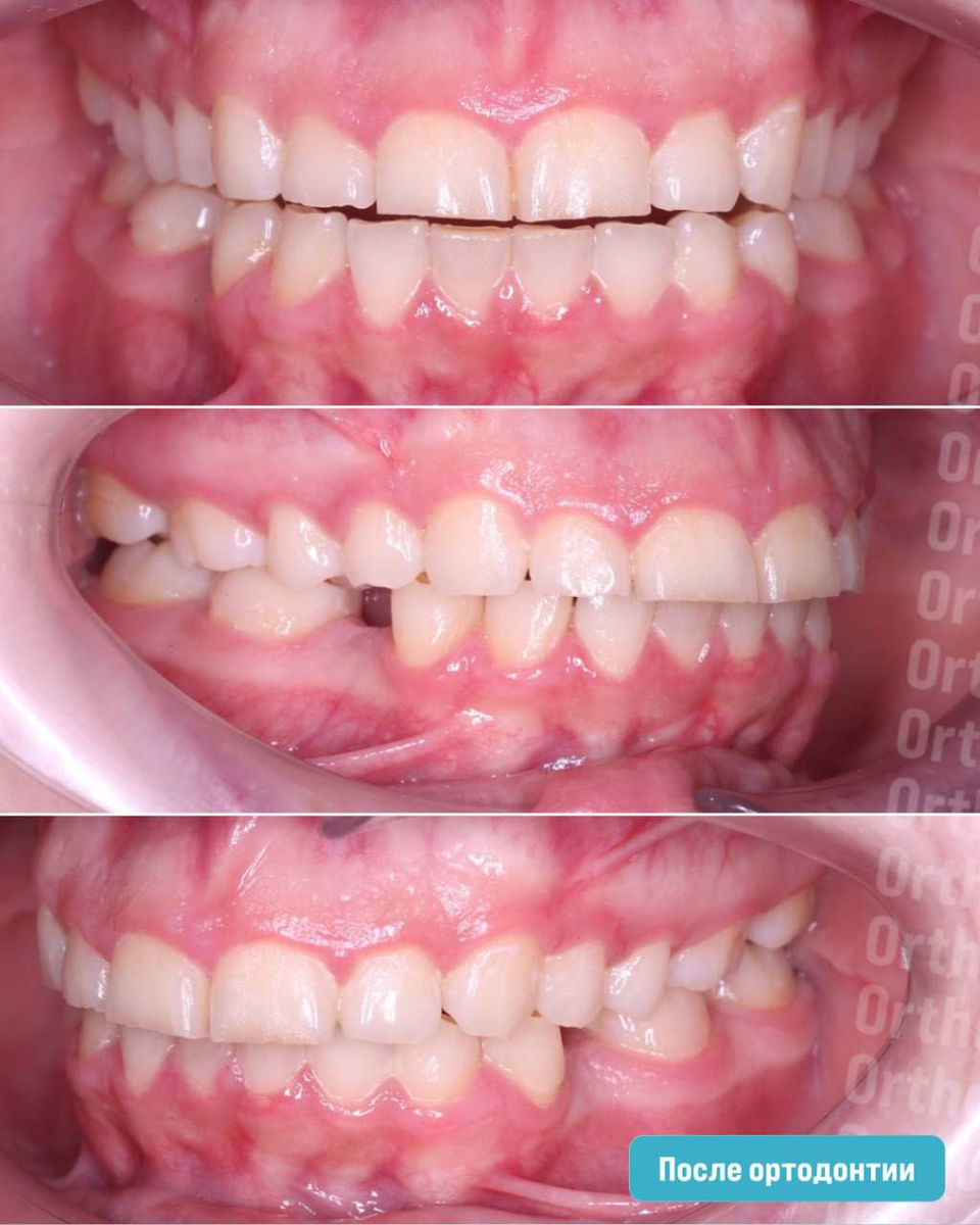 После ортодонтического лечения