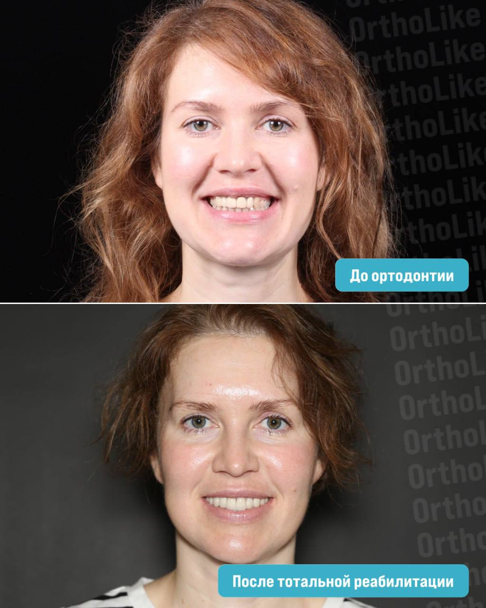 До и после тотальной реабилитации