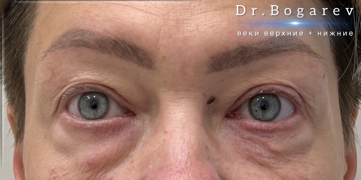 У пациентки была травма в области левого нижнего века. 